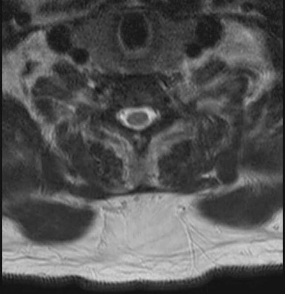 File:Brown tumors compressing the spinal cord (Radiopaedia 68442-78030 A 56).jpg