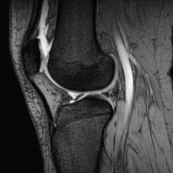 File:Bucket handle tear - medial meniscus (Radiopaedia 79028-91942 D 9).jpg