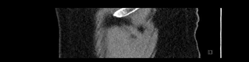 File:Buried bumper syndrome - gastrostomy tube (Radiopaedia 63843-72575 Sagittal Inject 116).jpg