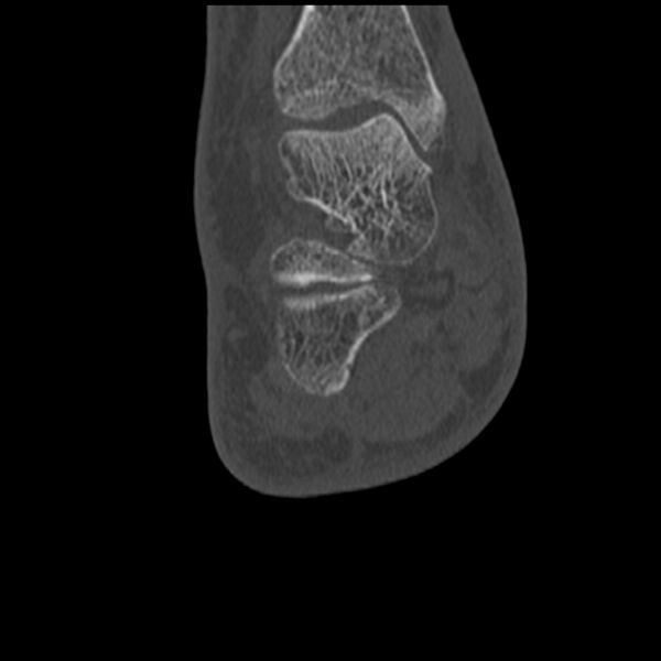 File:Calcaneal tuberosity avulsion fracture (Radiopaedia 22649-22668 Coronal bone window 46).jpg
