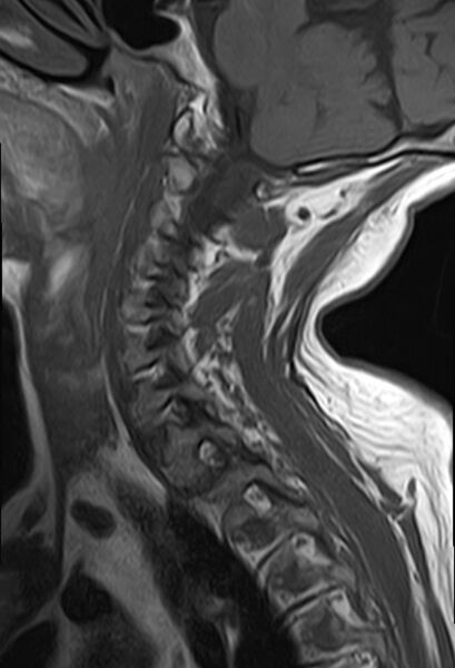 File:Calcified meningioma - cervical canal (Radiopaedia 70136-82468 Sagittal T1 5).jpg