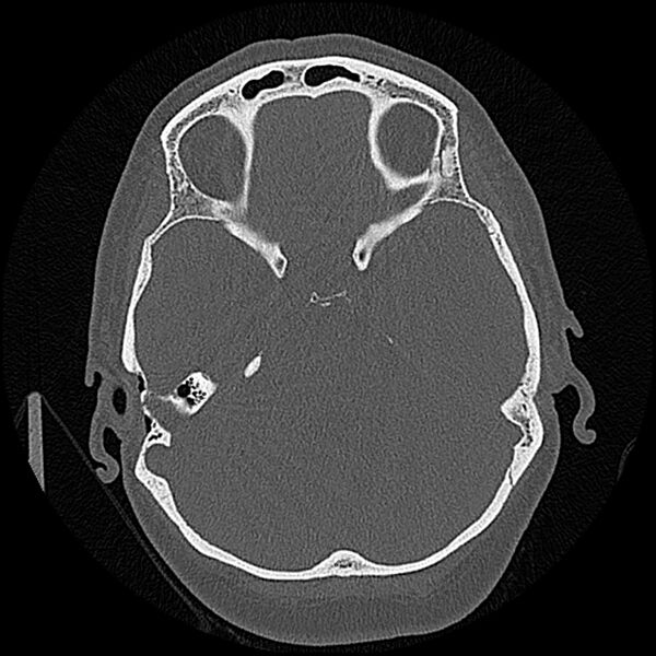 File:Canal up mastoidectomy (Radiopaedia 78108-90638 Axial bone window 109).jpg
