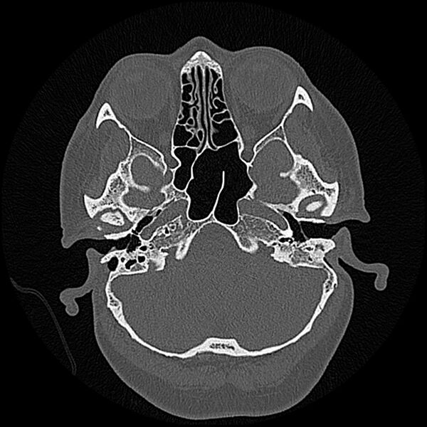 File:Canal up mastoidectomy (Radiopaedia 78108-90638 Axial bone window 53).jpg