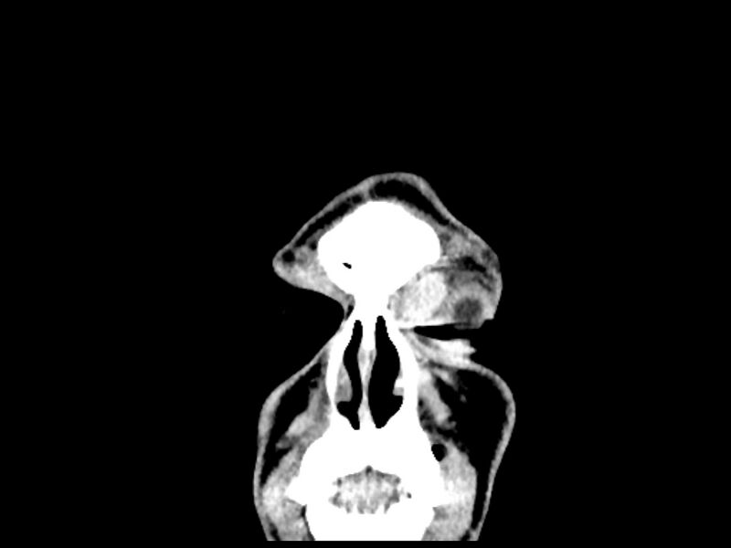 File:Capillary hemangioma of the orbit (Radiopaedia 44610-48358 B 15).jpg
