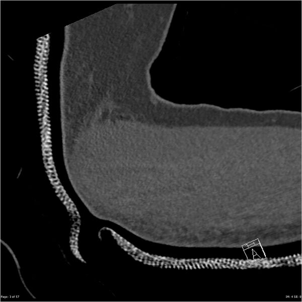 File:Capitellum fracture (Radiopaedia 23352-23426 Sagittal bone window 3).jpg