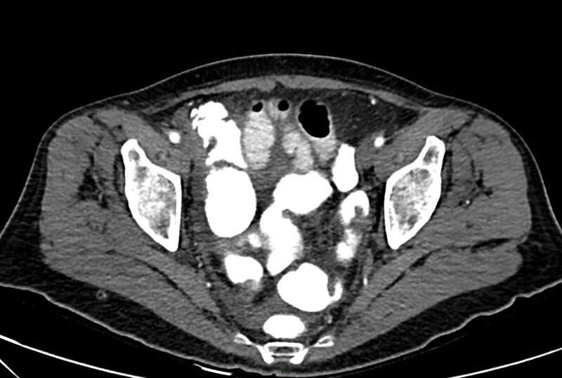 File:Carcinoid mesenteric tumor complicated by chylous ascites (Radiopaedia 76312-88926 A 66).jpg