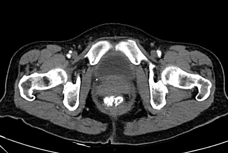File:Carcinoid mesenteric tumor complicated by chylous ascites (Radiopaedia 76312-88926 A 77).jpg