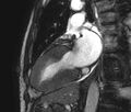 Cardiac amyloidosis (Radiopaedia 39736-42124 B 14).jpg