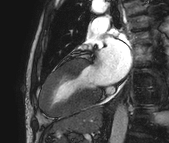 File:Cardiac amyloidosis (Radiopaedia 39736-42124 B 14).jpg
