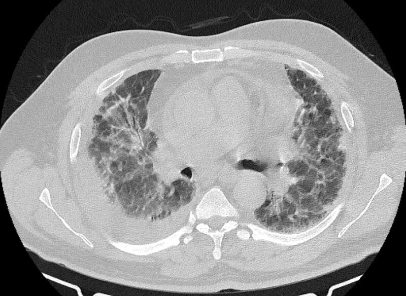 File:Cardiogenic pulmonary edema (Radiopaedia 68180-77678 Axial lung window 41).jpg
