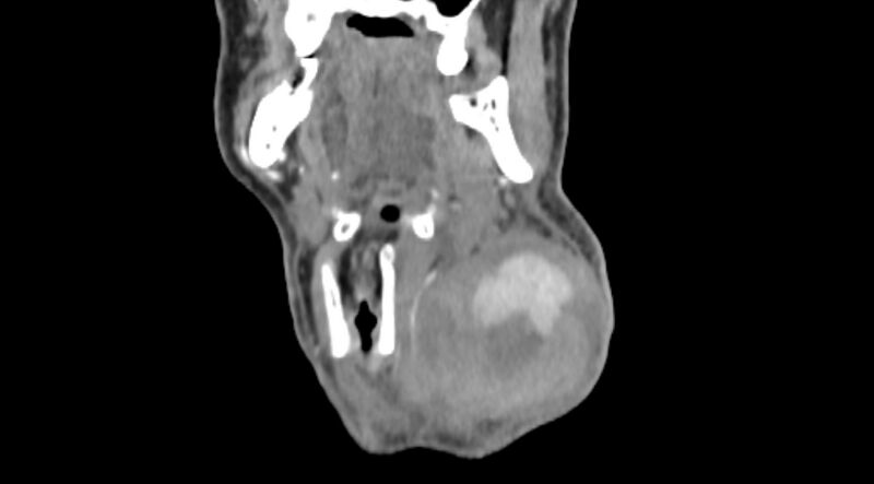 File:Carotid artery pseudoaneurysm (Radiopaedia 84030-99259 D 18).jpg