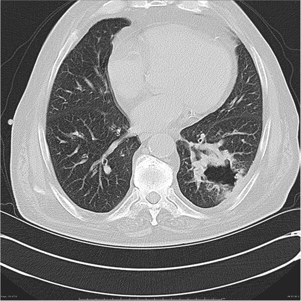 File:Cavitating left lower lobe lesion - squamous cell lung cancer (Radiopaedia 27749-28176 Axial lung window 33).jpg