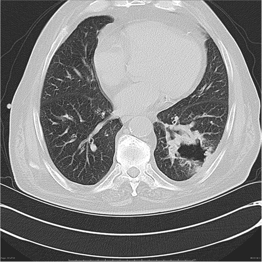 Cavitating left lower lobe lesion - squamous cell lung cancer (Radiopaedia 27749-28176 Axial lung window 33).jpg