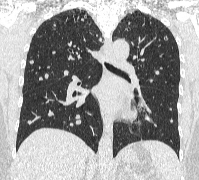 File:Cavitating pulmonary metastases (Radiopaedia 17796-17555 Coronal lung window 15).jpg