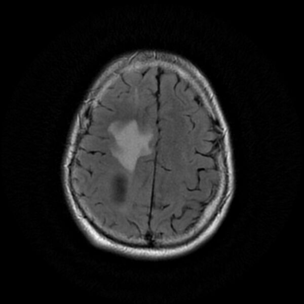 File:Central neurocytoma (Radiopaedia 67618-77021 Axial FLAIR 20).jpg