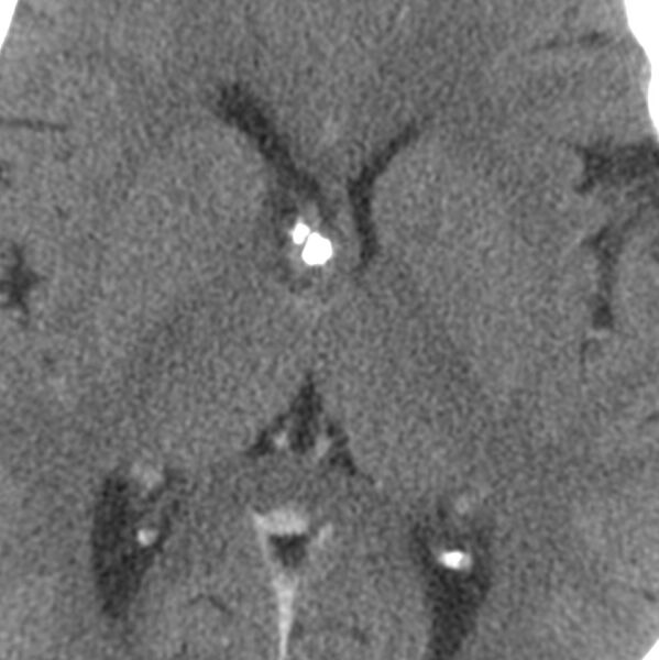 File:Central neurocytoma (Radiopaedia 68725-78432 C 22).jpg