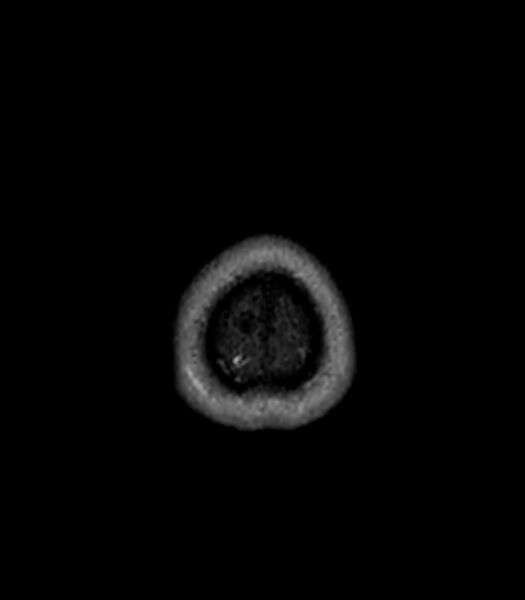 File:Central neurocytoma (Radiopaedia 79320-92380 Axial FLAIR 22).jpg