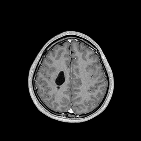 File:Central neurocytoma (Radiopaedia 79320-92380 Axial T1 C+ 178).jpg