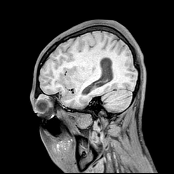 File:Central neurocytoma (Radiopaedia 79320-92380 Sagittal T1 193).jpg