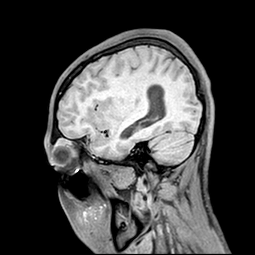 Central neurocytoma (Radiopaedia 79320-92380 Sagittal T1 193).jpg