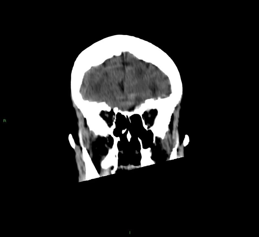 Cerebellar hemorrhage (Radiopaedia 58792-66026 Coronal non-contrast 49).jpg