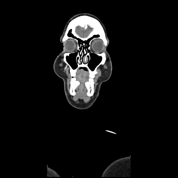 File:Cerebellar infarct due to vertebral artery dissection with posterior fossa decompression (Radiopaedia 82779-97029 D 8).png