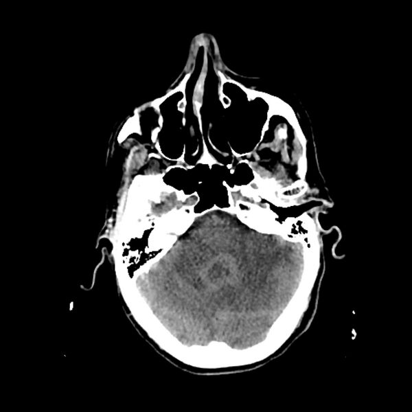 File:Cerebellar metastasis - lung tumor (Radiopaedia 69317-79145 Axial non-contrast 8).jpg