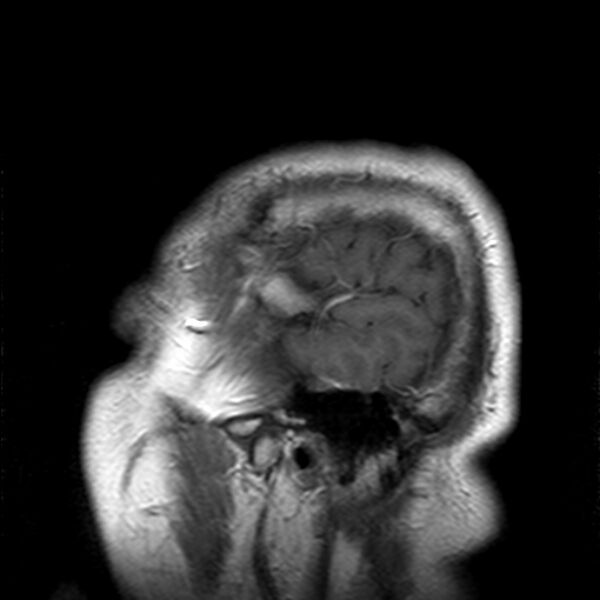 File:Cerebellopontine angle meningioma (Radiopaedia 24459-24764 Sagittal T1 C+ 1).jpg