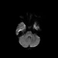 Cerebral abscess post cardiac surgery (Radiopaedia 27244-27420 Axial DWI 2).jpg