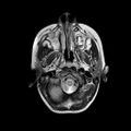 Cerebral abscess post cardiac surgery (Radiopaedia 27244-27420 Axial T2 2).jpg
