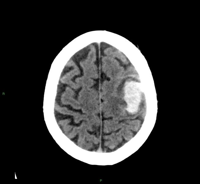 File:Cerebral amyloid angiopathy-associated lobar intracerebral hemorrhage (Radiopaedia 58376-65511 Axial non-contrast 15).jpg