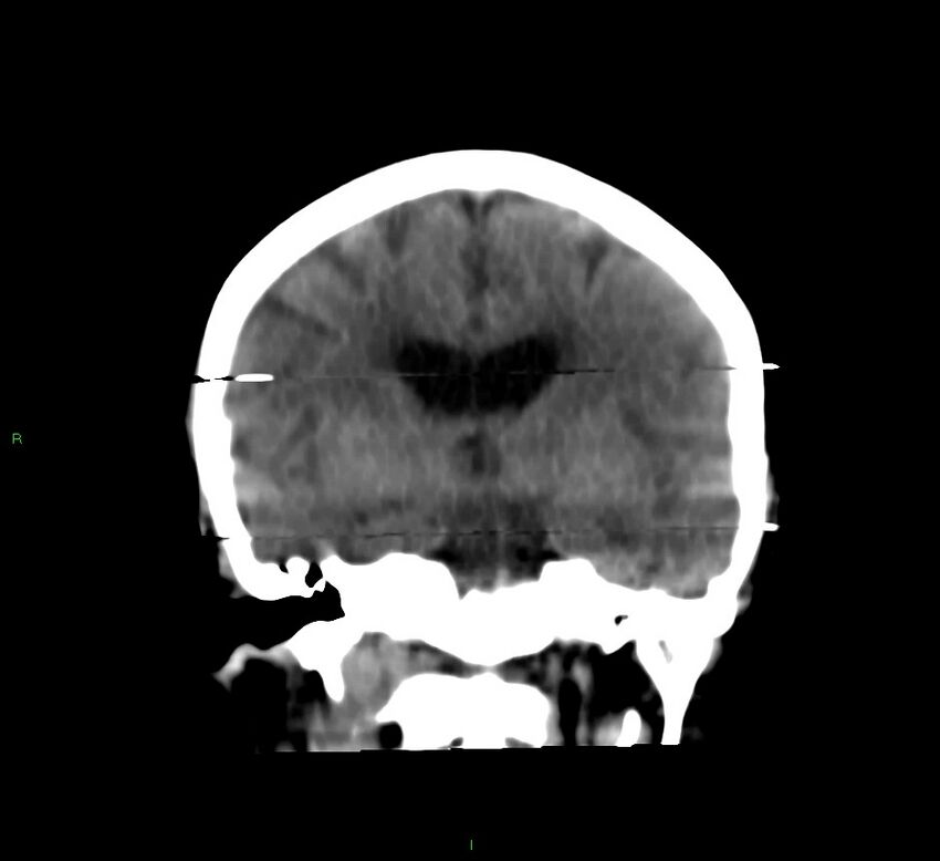 Cerebral amyloid angiopathy-associated lobar intracerebral hemorrhage (Radiopaedia 58377-65514 Coronal non-contrast 35).jpg