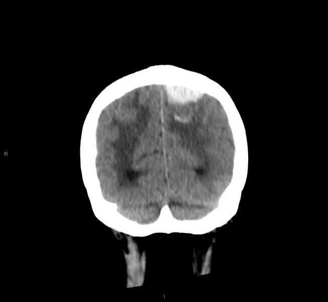 File:Cerebral amyloid angiopathy-associated lobar intracerebral hemorrhage (Radiopaedia 58530-65688 Coronal non-contrast 15).jpg