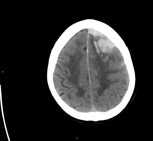File:Cerebral amyloid angiopathy-associated lobar intracerebral hemorrhage (Radiopaedia 58561-65724 Axial non-contrast 11).jpg