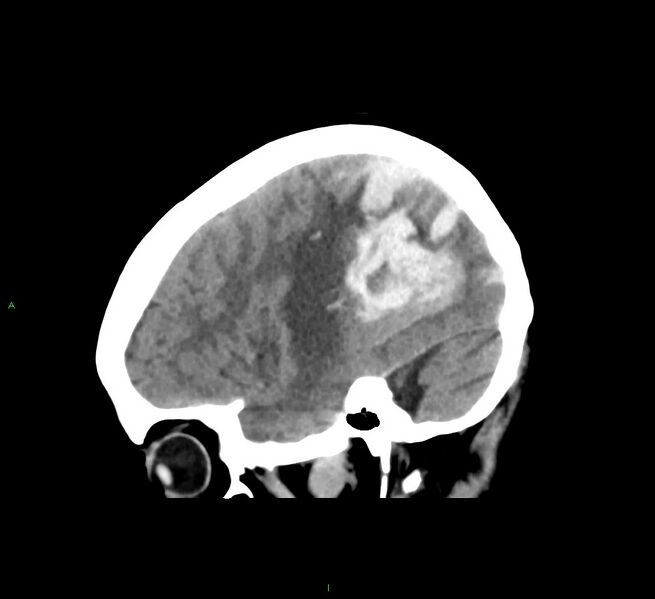 File:Cerebral amyloid angiopathy-associated lobar intracerebral hemorrhage (Radiopaedia 58563-65727 C 16).jpg