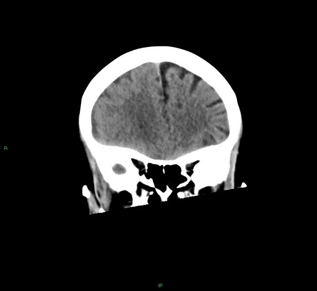 File:Cerebral amyloid angiopathy-associated lobar intracerebral hemorrhage (Radiopaedia 58563-65727 Coronal non-contrast 48).jpg