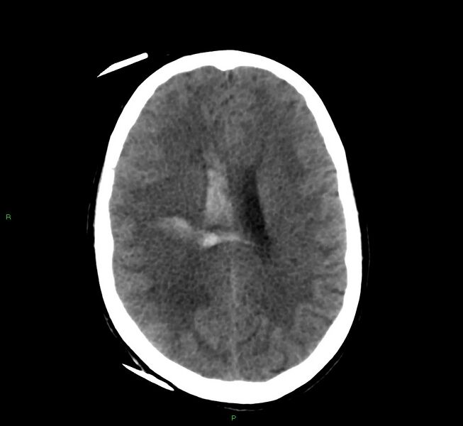 File:Cerebral amyloid angiopathy-associated lobar intracerebral hemorrhage (Radiopaedia 58566-65730 Axial non-contrast 21).jpg