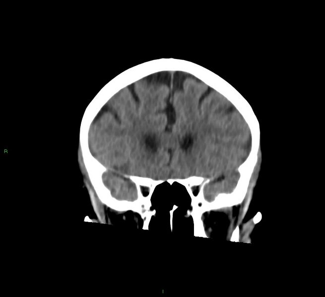 File:Cerebral amyloid angiopathy-associated lobar intracerebral hemorrhage (Radiopaedia 58757-65978 Coronal non-contrast 47).jpg