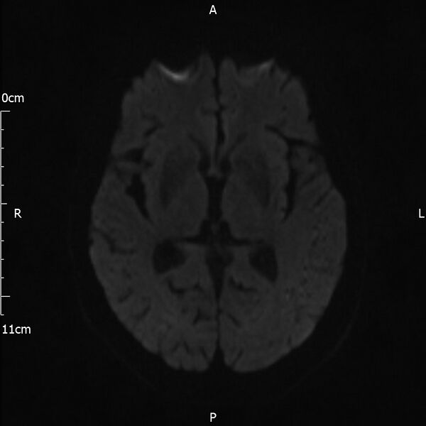 File:Cerebral amyloid angiopathy related inflammation (Radiopaedia 72772-83415 Axial DWI 58).jpg