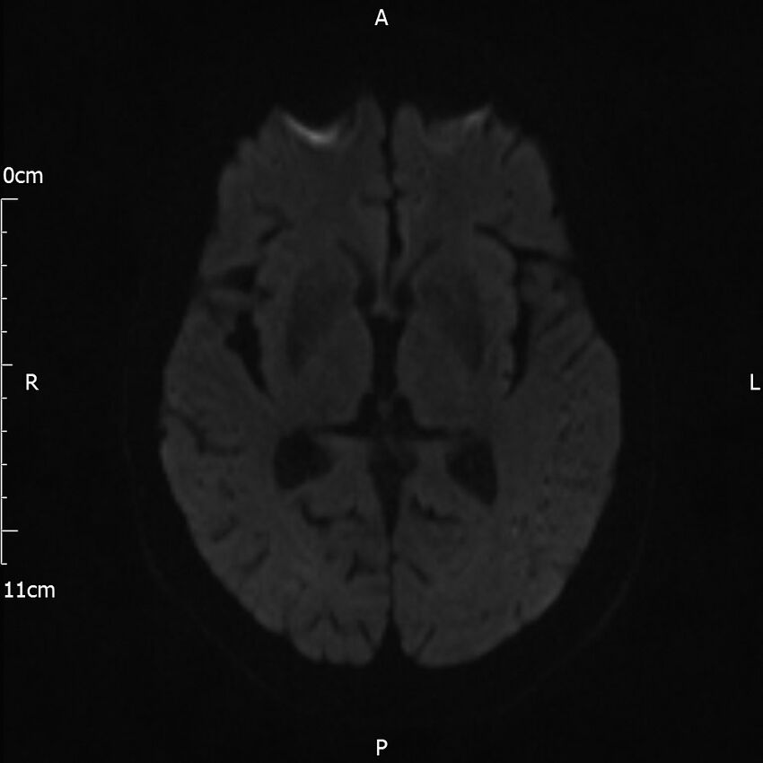 Cerebral amyloid angiopathy related inflammation (Radiopaedia 72772-83415 Axial DWI 58).jpg