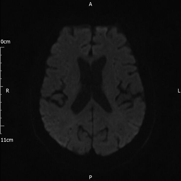 File:Cerebral amyloid angiopathy related inflammation (Radiopaedia 72772-83415 Axial DWI 60).jpg