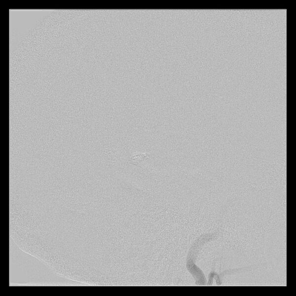 File:Cerebral aneurysm with rupture (Radiopaedia 29933-30458 LT ICA IC 37).jpg