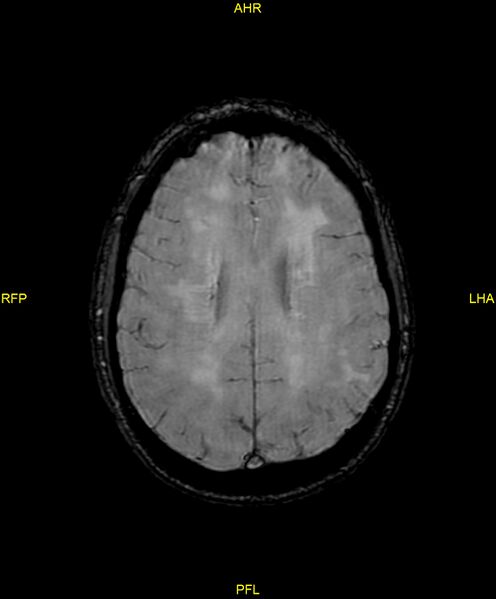 File:Cerebral autosomal dominant arteriopathy with subcortical infarcts and leukoencephalopathy (CADASIL) (Radiopaedia 86108-102054 Axial SWI 73).jpg