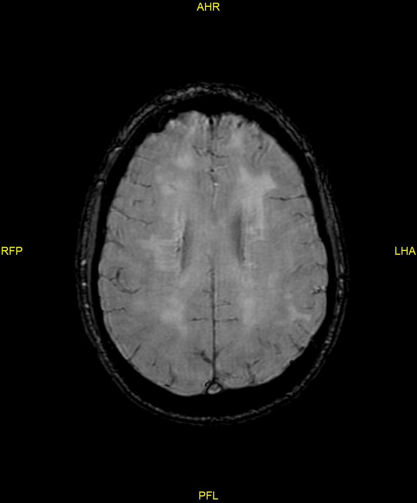 Cerebral autosomal dominant arteriopathy with subcortical infarcts and leukoencephalopathy (CADASIL) (Radiopaedia 86108-102054 Axial SWI 73).jpg