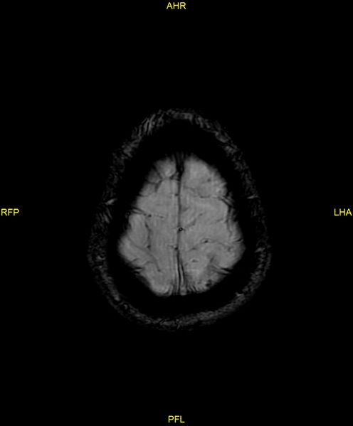 File:Cerebral autosomal dominant arteriopathy with subcortical infarcts and leukoencephalopathy (CADASIL) (Radiopaedia 86108-102054 Axial SWI 97).jpg