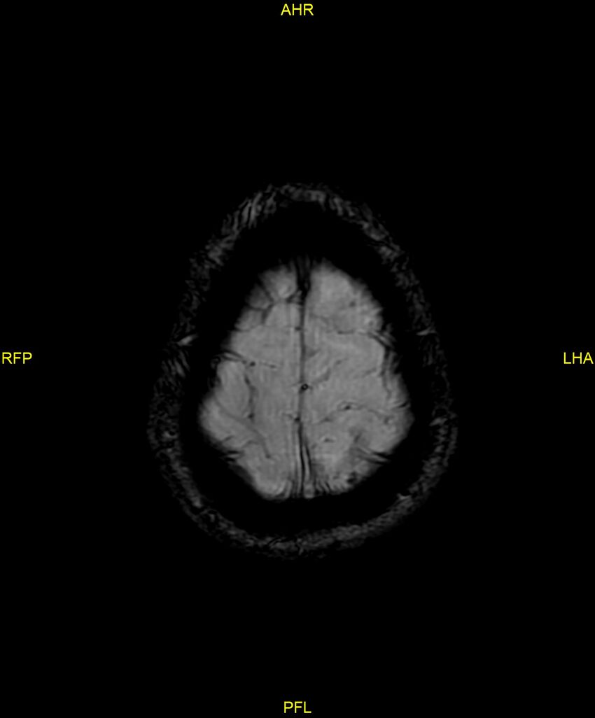 Cerebral autosomal dominant arteriopathy with subcortical infarcts and leukoencephalopathy (CADASIL) (Radiopaedia 86108-102054 Axial SWI 97).jpg