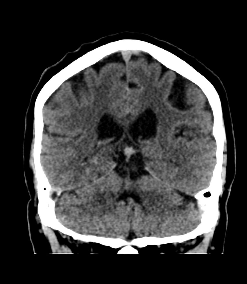 Cerebral dural venous sinus thrombosis (Radiopaedia 86514-102575 Coronal non-contrast 33).jpg