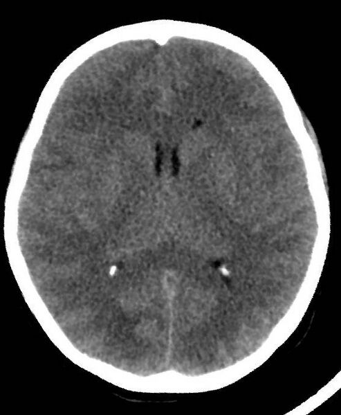 File:Cerebral edema due to severe hyponatremia (Radiopaedia 89826-106937 Axial non-contrast 48).jpg