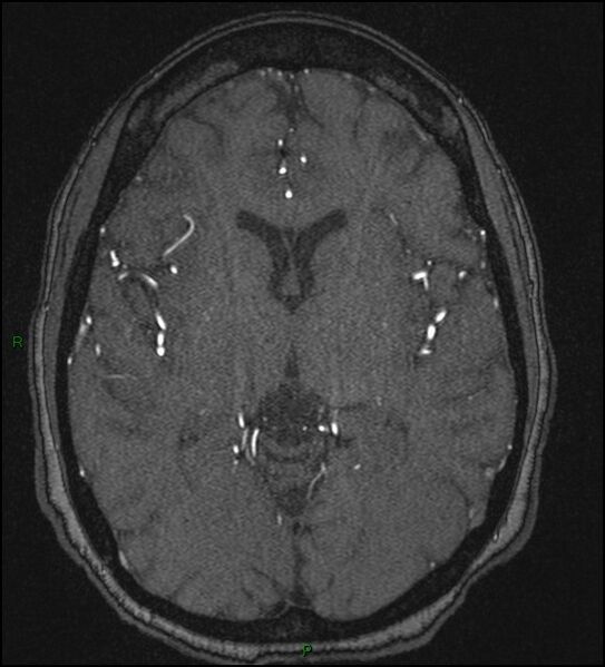 File:Cerebral fat embolism (Radiopaedia 35022-36525 Axial TOF 103).jpg