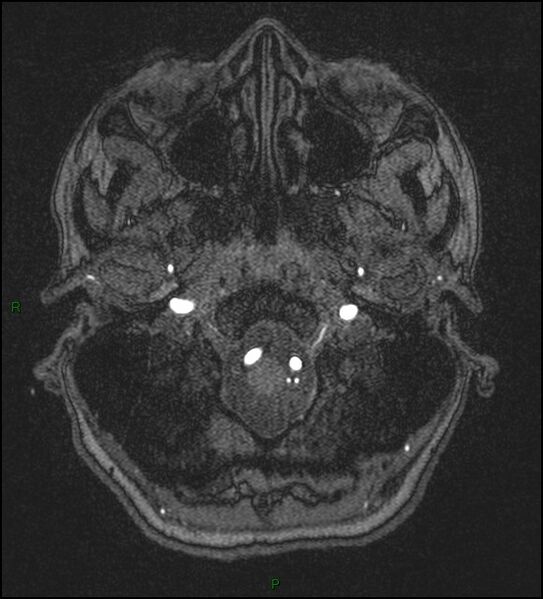 File:Cerebral fat embolism (Radiopaedia 35022-36525 Axial TOF 15).jpg
